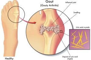 Microscopic view of needle-like uric acid crystals causing joint pain.