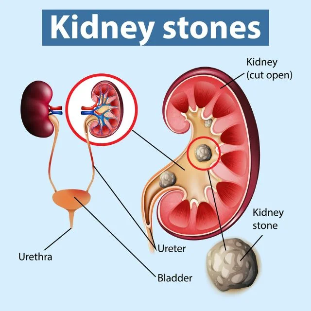 Diagram showing how high uric acid causes kidney stones.