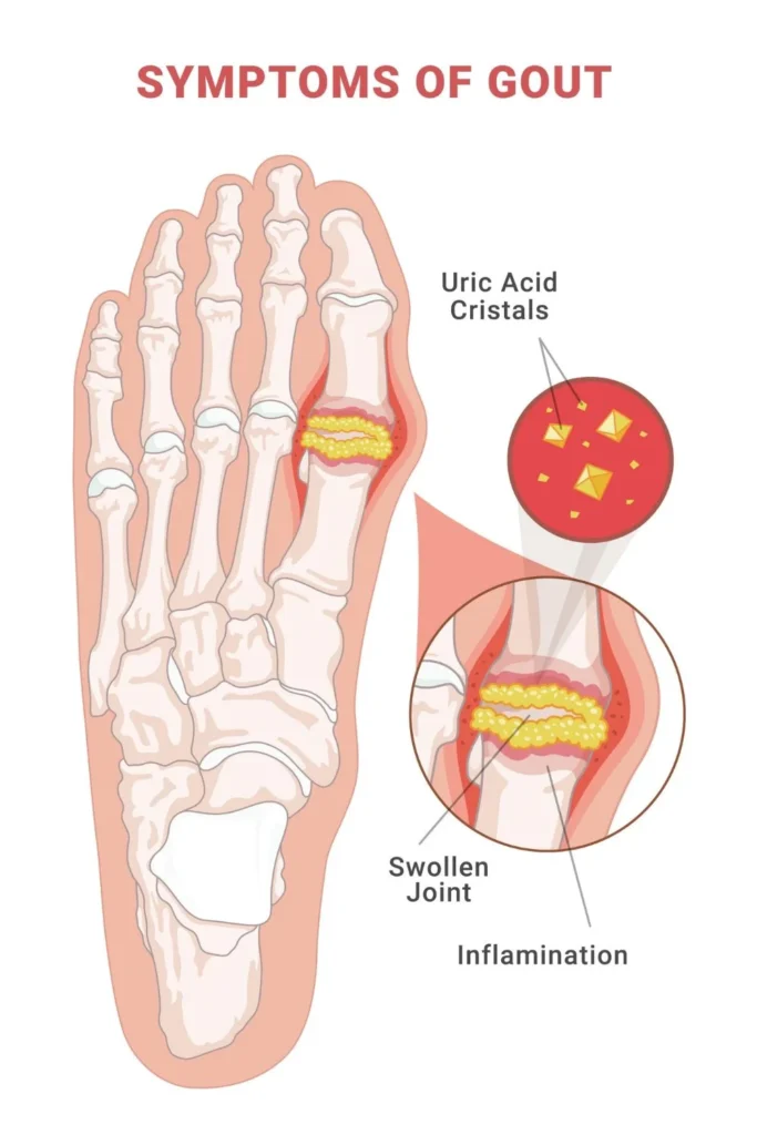 Red and swollen big toe indicating gout as an effect of high uric acid.